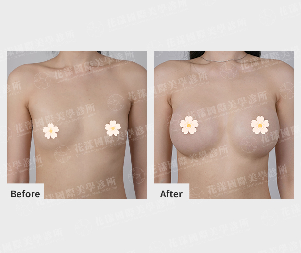 隆乳案例術前、術後比較(正面)