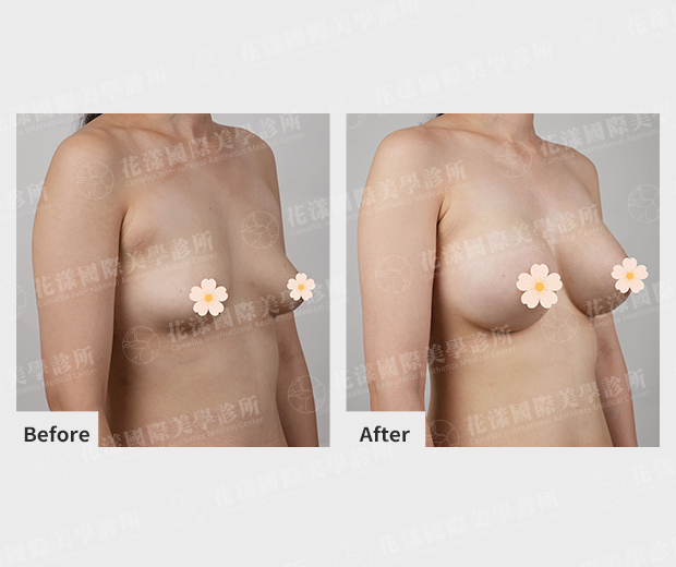 隆乳案例術前、術後比較(45度)