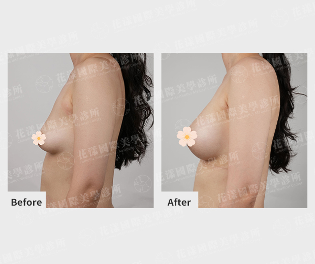 隆乳案例術前、術後比較(側面)