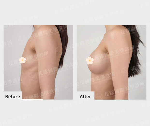 隆乳改善前後美麗見證 隆乳改善前後美麗見證