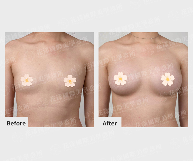 隆胸改善前後差異