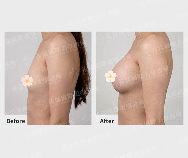 隆前前後改善差異