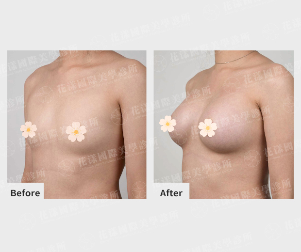 隆胸改善前後差異