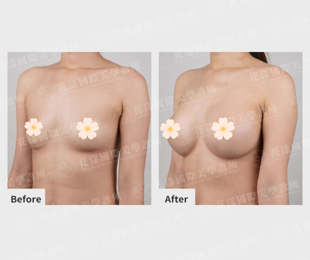 隆乳前後改善成果 隆乳前後改善成果