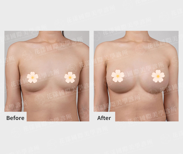 隆乳前後改善成果 隆乳前後改善成果