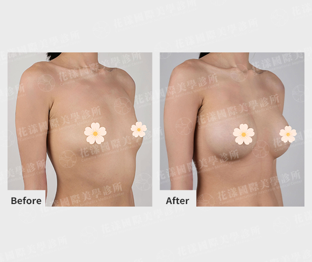 隆乳前後改善成果 隆乳前後改善成果