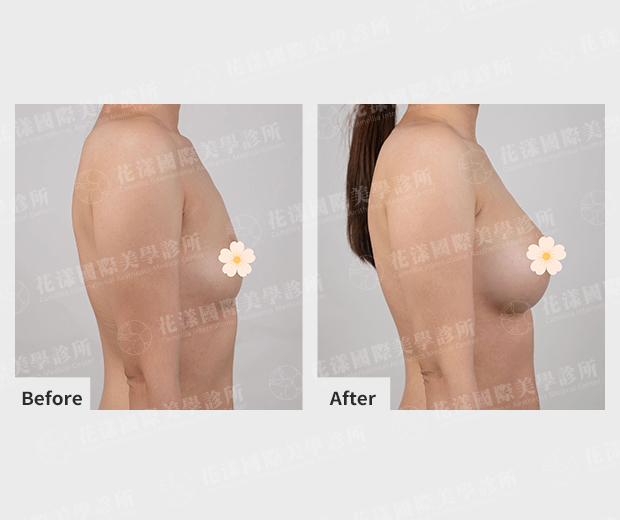 隆乳前後改善成果 隆乳前後改善成果