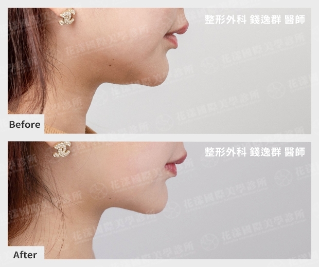 複合式天鵝頸改善前後成果