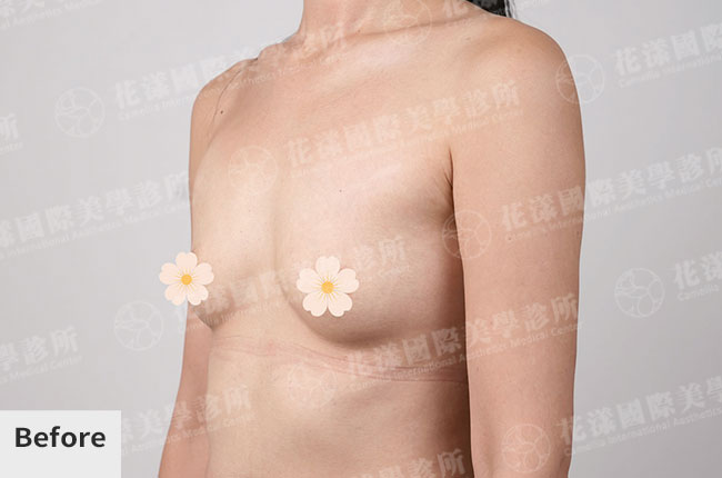 隆乳術前後改善成果