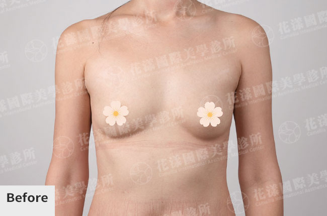 隆乳術前後改善成果