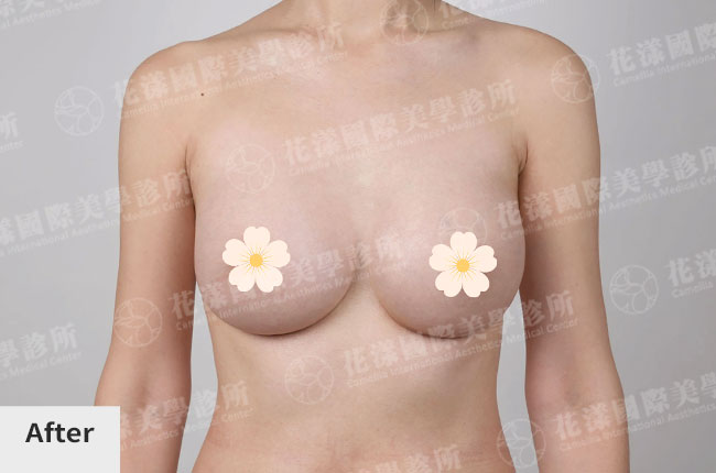 隆乳術前後改善成果