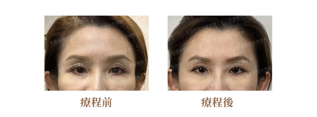 玻尿酸填充夫妻宮前後比較