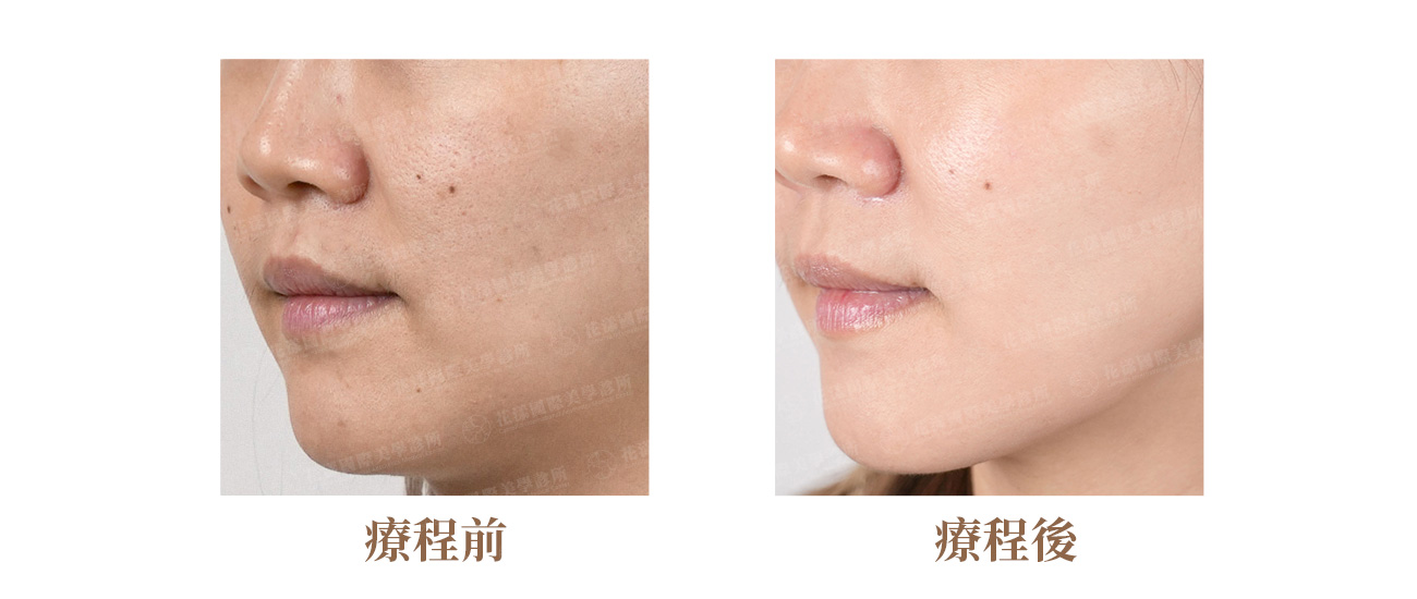 水光針療程前後比較 水光針療程前後比較