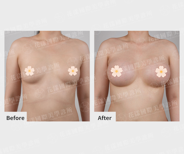 隆乳真實案例