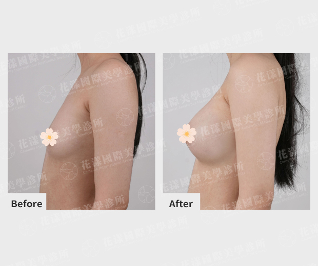 隆乳案例 隆乳案例