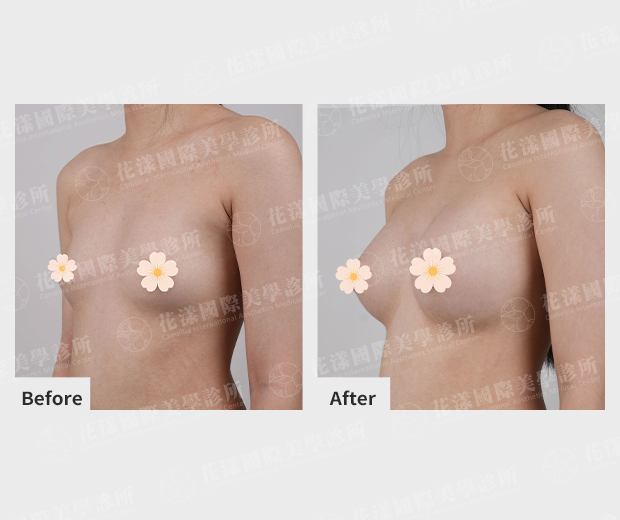 隆乳案例 隆乳案例