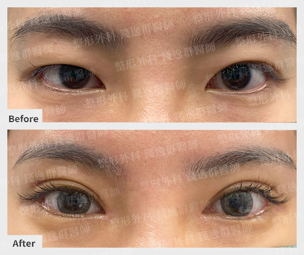 割雙眼皮案例 割雙眼皮案例
