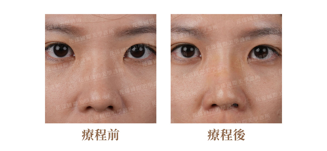 埋線山根鼻雕療程前後正面對比，山根墊高後眉心至鼻樑立體感提升｜花漾國際美學診所張家豪醫師