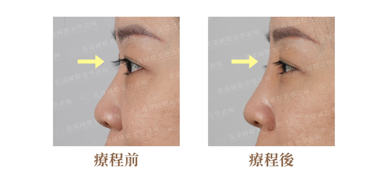埋線鼻雕案例：側面比對