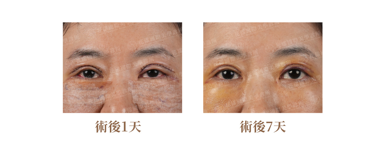 雙眼皮合併眼袋重修術後早期恢復期:術後1天與7天對比 錢逸群醫師雙眼皮合併眼袋重修術後早期恢復:術後1天眼周瘀血腫脹明顯、術後7天瘀血轉為黃色開始消退|花漾國際美學診所
