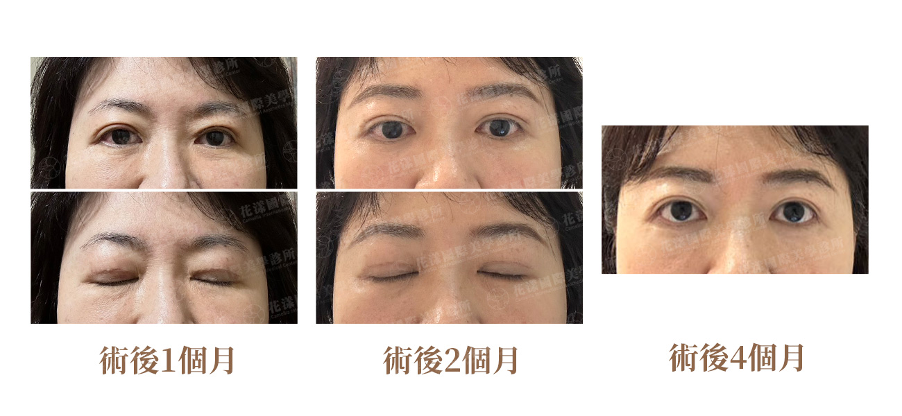 雙眼皮合併眼袋重修居家恢復期:術後1個月、2個月、4個月對比 錢逸群醫師雙眼皮合併眼袋重修居家恢復期對比:術後1個月仍有腫脹、2個月明顯改善、4個月成果穩定自然明亮|花漾國際美學診所