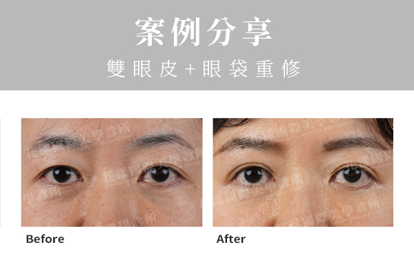 雙眼皮合併眼袋重修案例:術後6個月對比 錢逸群醫師雙眼皮合併眼袋重修術前術後比:術後6個月成果穩定自然明亮|花漾國際美學診所