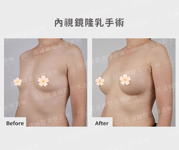 天生小胸隆乳前後參考(45度) 天生小胸隆乳前後參考(45度):術後胸線飽滿自然、觸感柔軟