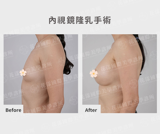 天生小胸隆乳前後比較(側面) 天生小胸隆乳前後比較(側面):術後胸型呈自然弧度、比例協調