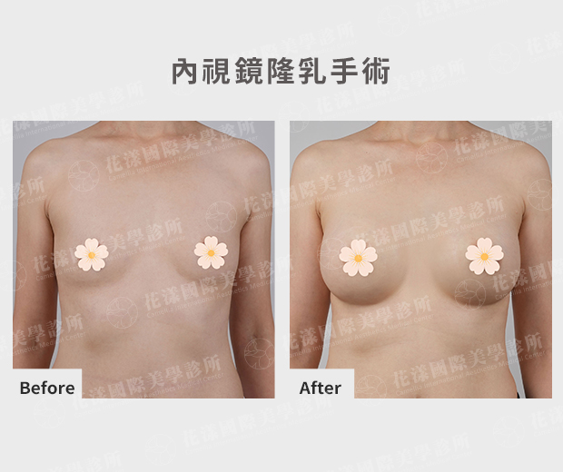 天生小胸隆乳前後對比(正面) 天生小胸隆乳前後對比(正面):術前上胸扁平,術後自然撐起穿衣有型