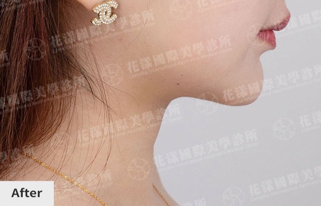 天鵝頸案例：術後展現緊緻俐落的側顏線條