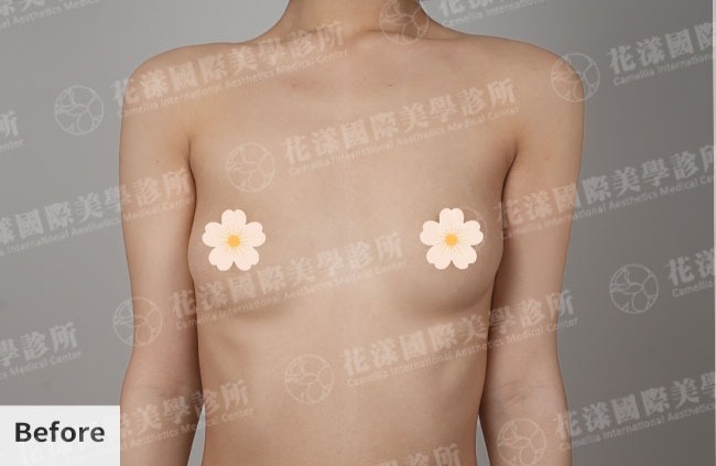 隆乳案例 隆乳案例