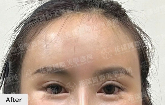 前額拉皮提眉手術前後對比：錢逸群醫師額拉案例