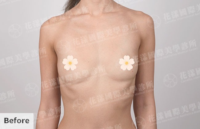 隆乳術前後改善成果