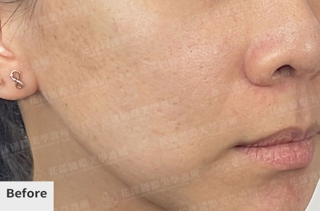 水光針案例：改善毛孔粗大與油水平衡的膚質調理